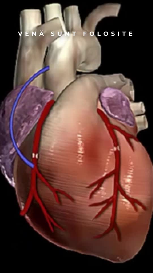 Bypassul Cardiac Explicat Vizual – Ce Se Întâmplă cu Inima?   # Gupi