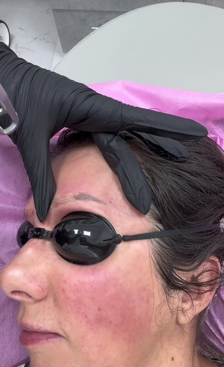 Infrpartare tatuaj cu laser