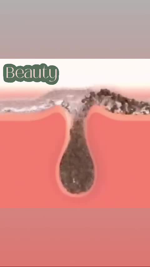 👌✨ MEZO PURE 

  Porii dilatați, sebumul în exces și textura neuniformă a pielii pot fi corectate elegant printr-un singur tratament: Mezo Pure 💧