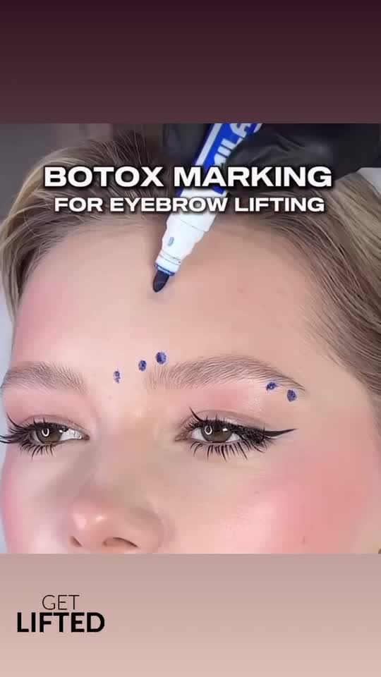✨ Botox Brow Lift  ✨

O procedură rapidă și minim invazivă care deschide privirea, ridică sprâncenele și oferă un aspect proaspăt și întinerit.